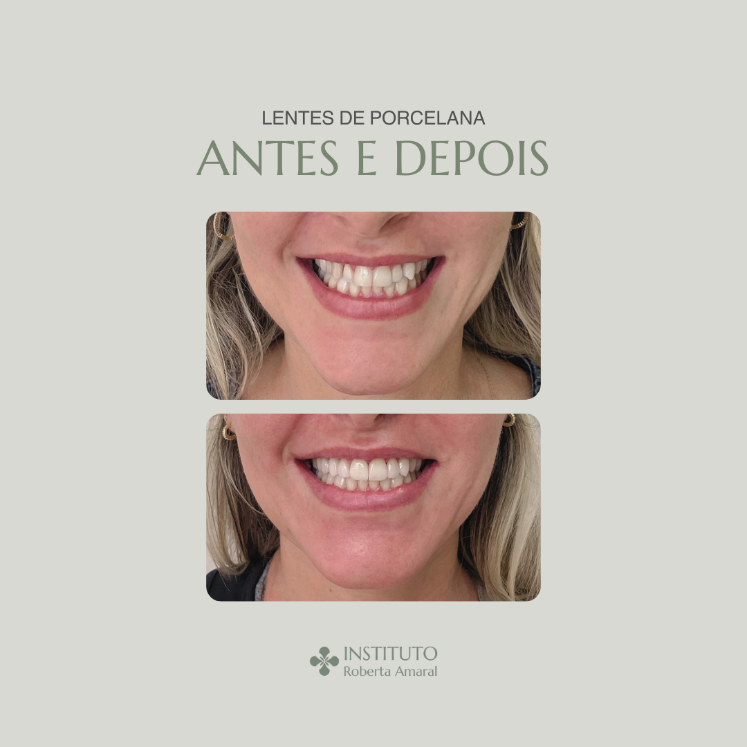 Facetas Dentárias de Porcelana