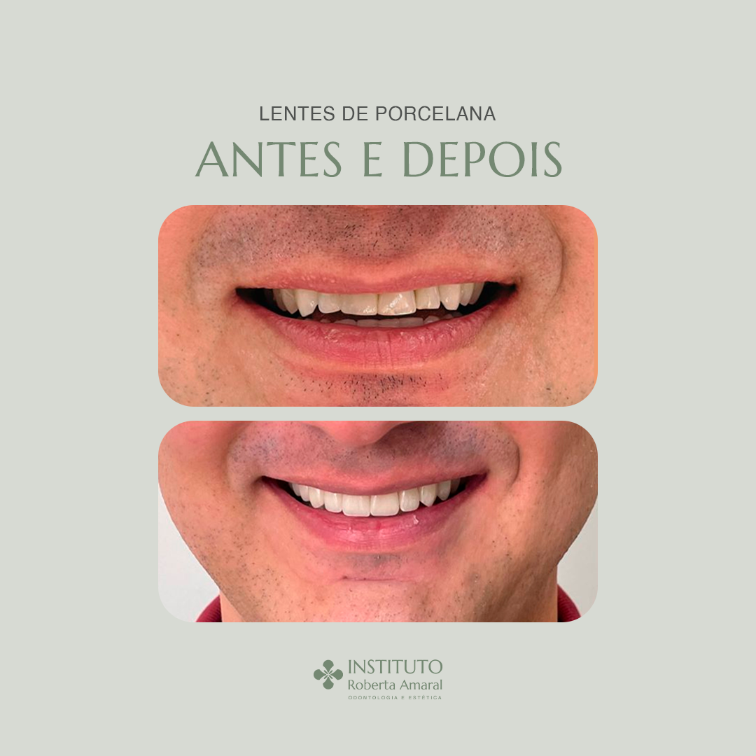 Facetas Dentárias em Porcelana